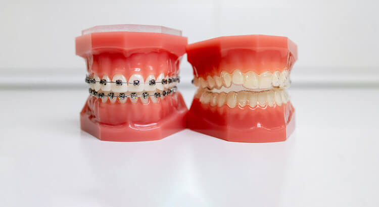 Two sets of fake teeth side by side, one with braces, once with clear aligners